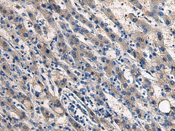 Immunohistochemistry of paraffin-embedded Human liver cancer tissue  using COL17A1 Polyclonal Antibody at dilution of 1:50(?200)