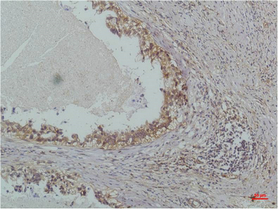 Immunohistochemistry of paraffin-embedded Human lung carcinoma tissue using NFKBIB Monoclonal Antibody at dilution of 1:200.