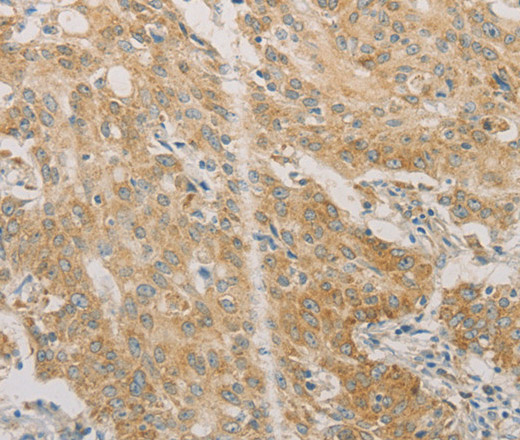 Immunohistochemistry of paraffin-embedded Human gastric cancer using ACSL4 Polyclonal Antibody at dilution of 1:60