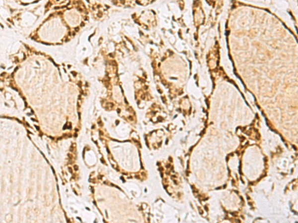 Immunohistochemistry of paraffin-embedded Human thyroid cancer tissue  using NIPBL Polyclonal Antibody at dilution of 1:55(?200)