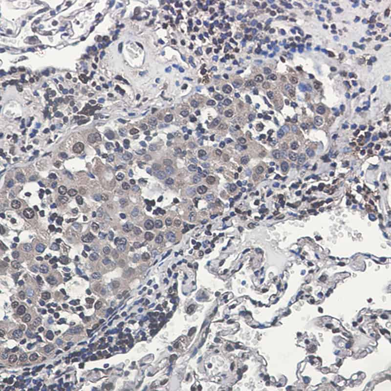 Immunohistochemistry of Rsk 2/MAPKAP Kinase 1b in paraffin-embedded Human lung cancer tissue using Rsk 2/MAPKAP Kinase 1b Rabbit mAb at dilution 1:50