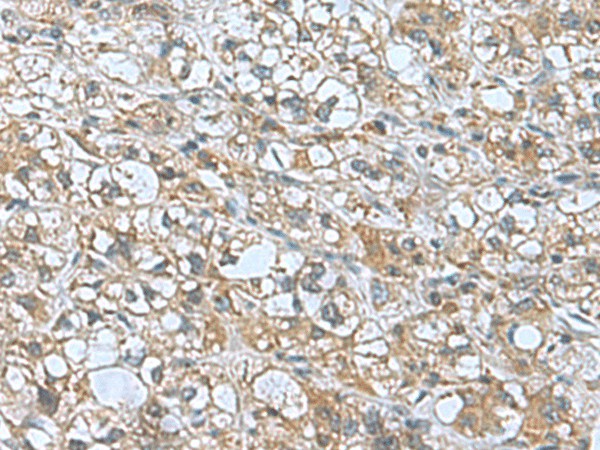 Immunohistochemistry of paraffin-embedded Human liver cancer tissue  using KANSL1L Polyclonal Antibody at dilution of 1:55(?200)