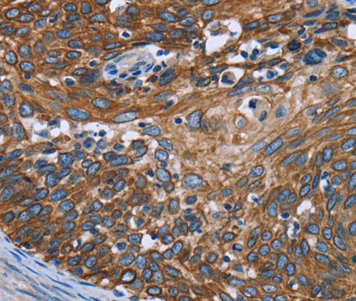 Immunohistochemistry of paraffin-embedded Human cervical cancer tissue using FCGR3A Polyclonal Antibody at dilution 1:40