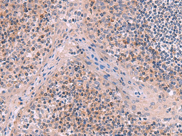 Immunohistochemistry of paraffin-embedded Human tonsil tissue  using ITIH4 Polyclonal Antibody at dilution of 1:50(?200)