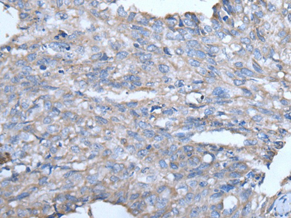 Immunohistochemistry of paraffin-embedded Human lung cancer tissue  using GJA1 Polyclonal Antibody at dilution of 1:50(?200)