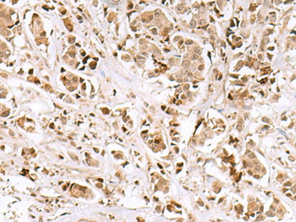 Immunohistochemistry of paraffin-embedded Human breast cancer tissue  using INSM1 Polyclonal Antibody at dilution of 1:50(?200)