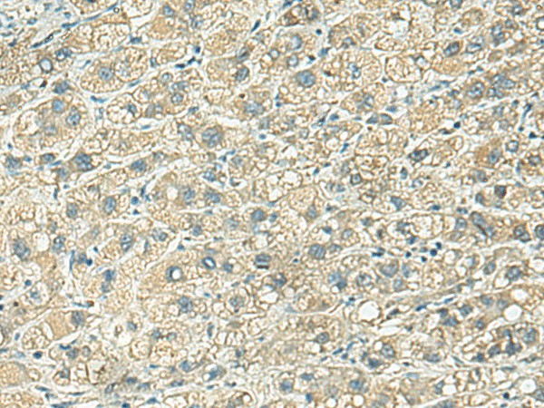 Immunohistochemistry of paraffin-embedded Human liver cancer tissue  using KLC2 Polyclonal Antibody at dilution of 1:100(?200)