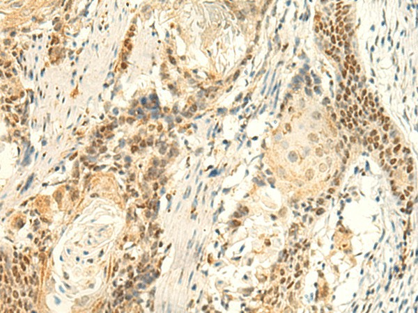 Immunohistochemistry of paraffin-embedded Human esophagus cancer tissue  using HMBOX1 Polyclonal Antibody at dilution of 1:50(?200)