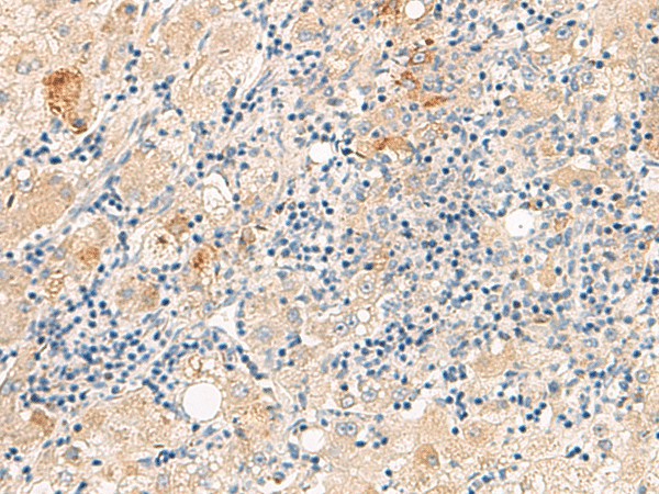 Immunohistochemistry of paraffin-embedded Human liver cancer tissue  using THNSL1 Polyclonal Antibody at dilution of 1:70(?200)