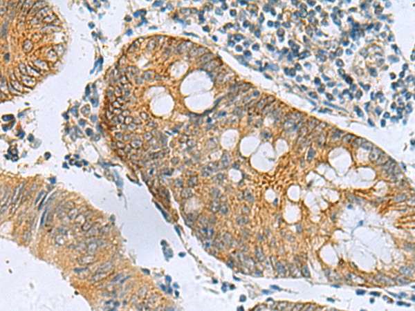 Immunohistochemistry of paraffin-embedded Human colorectal cancer tissue  using GUCA1A Polyclonal Antibody at dilution of 1:105(?200)