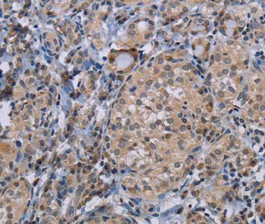 Immunohistochemistry of paraffin-embedded Human thyroid cancer using CDC16 Polyclonal Antibody at dilution of 1:50