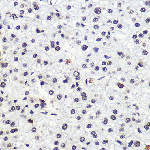 Immunohistochemistry of paraffin-embedded human liver cancer using MSH6 Polyclonal Antibody at dilution of 1:100 (40x lens).Perform microwave antigen retrieval with 10 mM Tris/EDTA buffer pH 9.0 before commencing with IHC staining protocol.