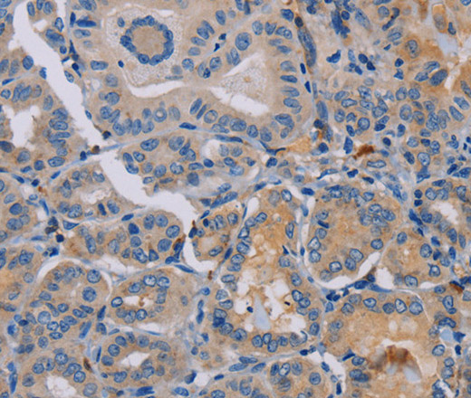 Immunohistochemistry of paraffin-embedded Human thyroid cancer tissue using PYY Polyclonal Antibody at dilution 1:30