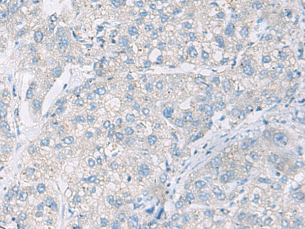 Immunohistochemistry of paraffin-embedded Human liver cancer tissue  using DACT3 Polyclonal Antibody at dilution of 1:55(?200)