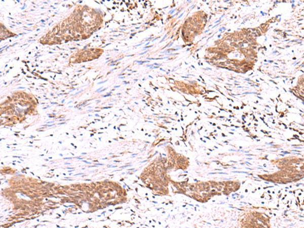 Immunohistochemistry of paraffin-embedded Human esophagus cancer tissue  using SASH1 Polyclonal Antibody at dilution of 1:30(?200)