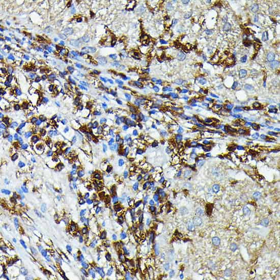 Immunohistochemistry of paraffin-embedded Human liver cancer using HLA-DPB1 Polyclonal Antibody at dilution of 1:100 (40x lens).Perform high pressure antigen retrieval with 10 mM citrate buffer pH 6.0 before commencing with IHC staining protocol.