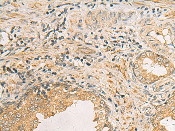 Immunohistochemistry of paraffin-embedded Human prost ate cancer tissue  using IDS Polyclonal Antibody at dilution of 1:70(?200)