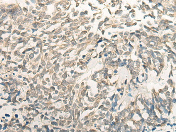 Immunohistochemistry of paraffin-embedded Human lung cancer tissue  using BCAS3 Polyclonal Antibody at dilution of 1:35(?200)