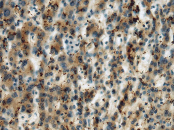 Immunohistochemistry of paraffin-embedded Human liver cancer tissue  using MICA Polyclonal Antibody at dilution of 1:60(?200)