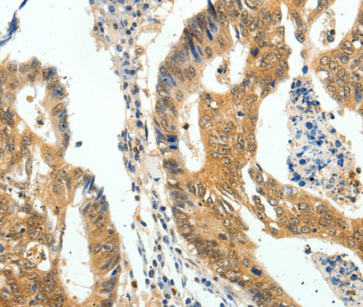 Immunohistochemistry of paraffin-embedded Human colon cancer tissue using Otocadherin Polyclonal Antibody at dilution 1:60
