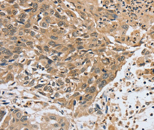 Immunohistochemistry of paraffin-embedded Human lung cancer tissue using PTPN4 Polyclonal Antibody at dilution 1:40