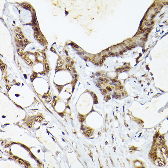 Immunohistochemistry of paraffin-embedded human colon carcinoma using UBQLN4 Polyclonal Antibody at dilution of 1:100 (40x lens).Perform high pressure antigen retrieval with 10 mM citrate buffer pH 6.0 before commencing with IHC staining protocol.