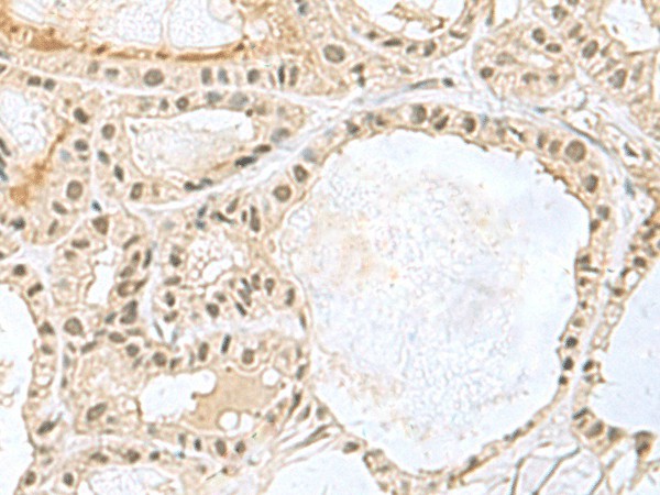 Immunohistochemistry of paraffin-embedded Human thyroid cancer tissue  using KDM3B Polyclonal Antibody at dilution of 1:45(?200)