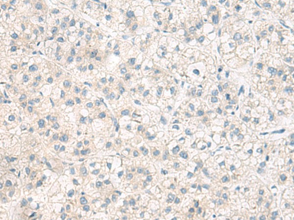 Immunohistochemistry of paraffin-embedded Human liver cancer tissue  using ANKS6 Polyclonal Antibody at dilution of 1:55(?200)