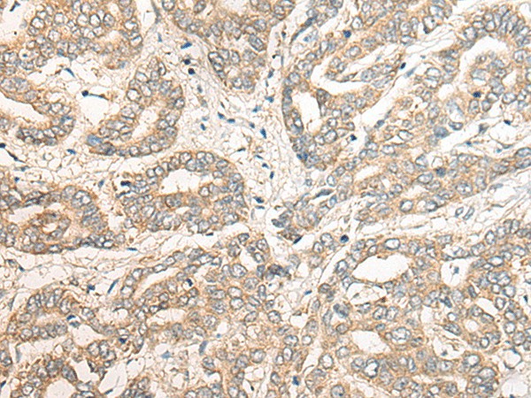 Immunohistochemistry of paraffin-embedded Human liver cancer tissue  using PCDHGB5 Polyclonal Antibody at dilution of 1:40(?200)