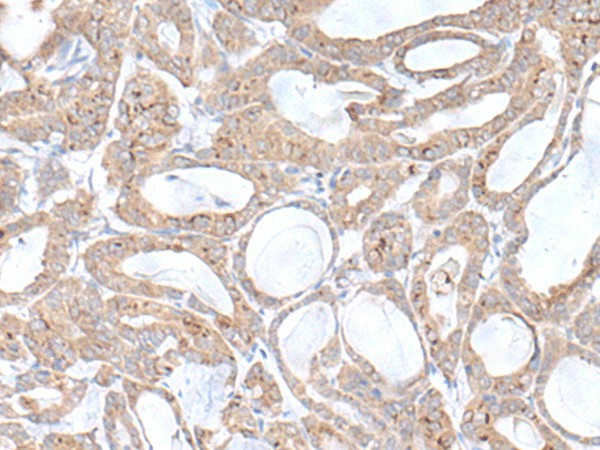 Immunohistochemistry of paraffin-embedded Human thyroid cancer tissue  using PLGLB2 Polyclonal Antibody at dilution of 1:65(?200)