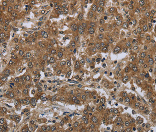 Immunohistochemistry of paraffin-embedded Human liver cancer tissue using GABRB1 Polyclonal Antibody at dilution 1:50