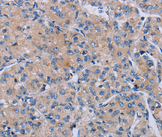 Immunohistochemistry of paraffin-embedded Human prostate cancer using P2RX3 Polyclonal Antibody at dilution of 1:50