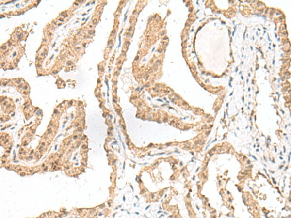 Immunohistochemistry of paraffin-embedded Human thyroid cancer tissue  using RALGAPA1 Polyclonal Antibody at dilution of 1:55(?200)