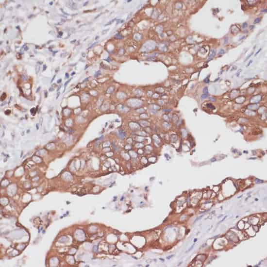 Immunohistochemistry of paraffin-embedded Human colon carcinoma using TPD52 Polyclonal Antibody at dilution of 1:100 (40x lens).