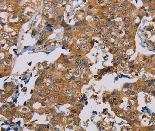 Immunohistochemistry of paraffin-embedded Human thyroid cancer using TAB3 Polyclonal Antibody at dilution of 1:35