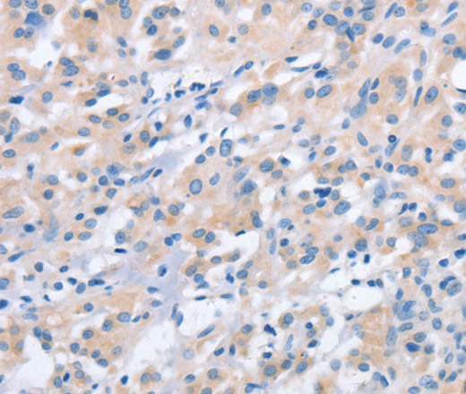 Immunohistochemistry of paraffin-embedded Human thyroid cancer using NCAPD2 Polyclonal Antibody at dilution of 1:40