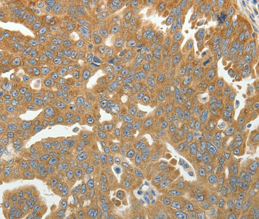 Immunohistochemistry of paraffin-embedded Human ovarian cancer using RPLP0 Polyclonal Antibody at dilution of 1:40