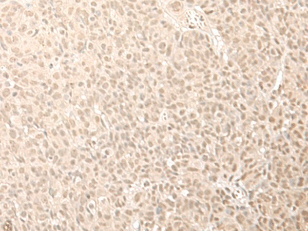 Immunohistochemistry of paraffin-embedded Human esophagus cancer tissue  using CNOT10 Polyclonal Antibody at dilution of 1:50(?200)