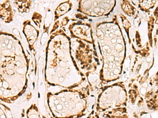 Immunohistochemistry of paraffin-embedded Human thyroid cancer tissue  using LRRC2 Polyclonal Antibody at dilution of 1:70(?200)