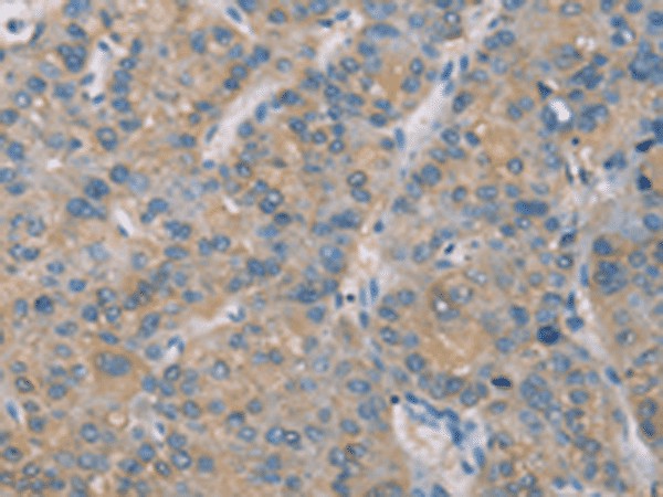 Immunohistochemistry of paraffin-embedded Human liver cancer tissue  using ZBTB6  Polyclonal Antibody at dilution of 1:50(?200)