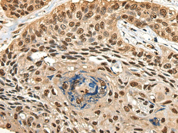 Immunohistochemistry of paraffin-embedded Human esophagus cancer tissue  using CCDC112 Polyclonal Antibody at dilution of 1:45(?200)