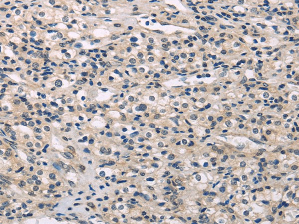 Immunohistochemistry of paraffin-embedded Human prostate cancer using MED28 Polyclonal Antibody at dilution of  1/30