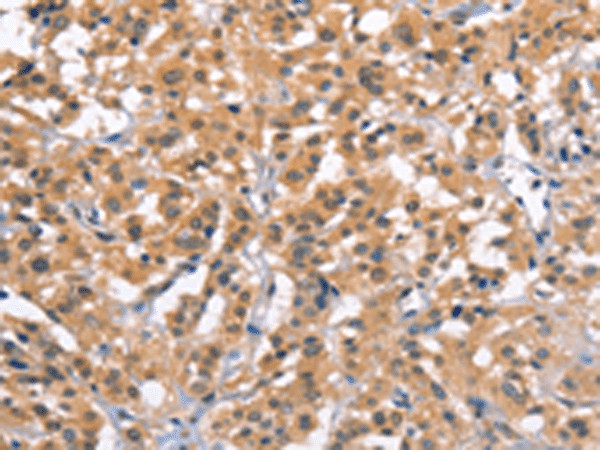 Immunohistochemistry of paraffin-embedded Human thyroid cancer tissue  using ZFYVE19  Polyclonal Antibody at dilution of 1:61(?200)