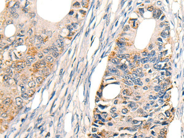 Immunohistochemistry of paraffin-embedded Human colorectal cancer tissue  using TNFRSF10D Polyclonal Antibody at dilution of 1:30(?200)