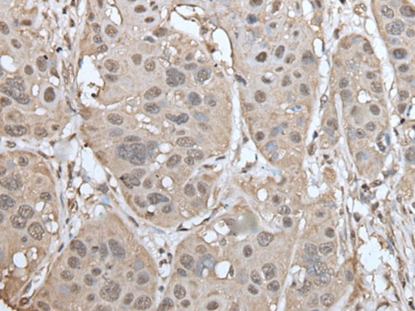 Immunohistochemistry of paraffin-embedded Human esophagus cancer tissue  using UBASH3A Polyclonal Antibody at dilution of 1:50(?200)