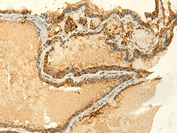 Immunohistochemistry of paraffin-embedded Human thyroid cancer tissue  using GLYATL2 Polyclonal Antibody at dilution of 1:50(?200)