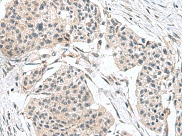 Immunohistochemistry of paraffin-embedded Human esophagus cancer tissue  using TPD52L3 Polyclonal Antibody at dilution of 1:140(?200)