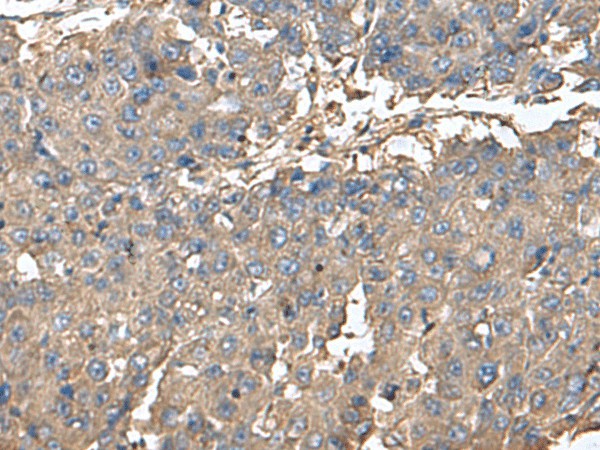 Immunohistochemistry of paraffin-embedded Human liver cancer tissue  using BLOC1S6 Polyclonal Antibody at dilution of 1:95(?200)