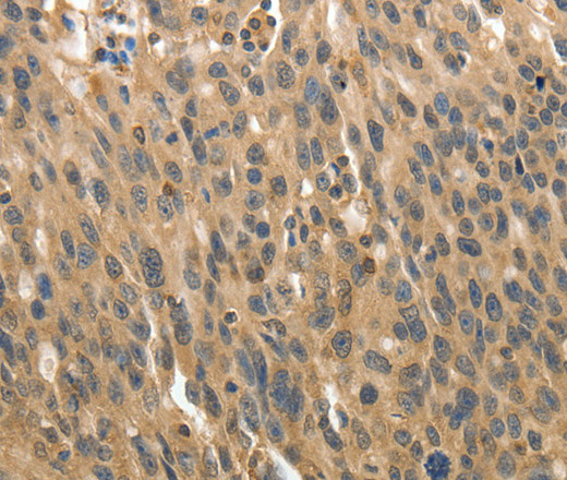 Immunohistochemistry of paraffin-embedded Human ovarian cancer using MSN Polyclonal Antibody at dilution of 1:30