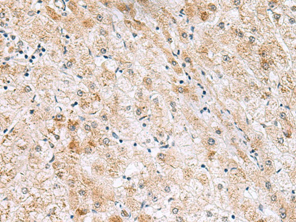 Immunohistochemistry of paraffin-embedded Human liver cancer tissue  using GPC2 Polyclonal Antibody at dilution of 1:40(?200)